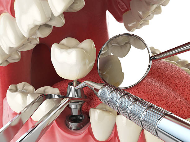 Emergency Dental Filling Replacement in AZ